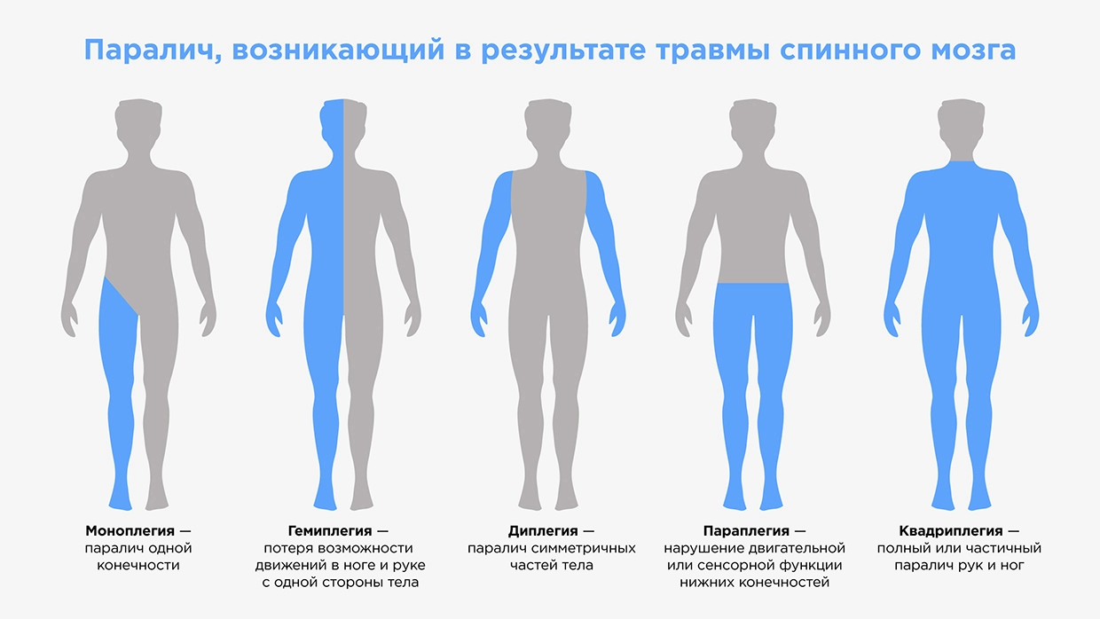 Травма спинного мозга - причины, симптомы, диагностика и лечение